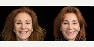 Smile Makeover before and after photo