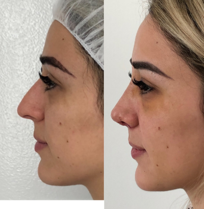 Rhinoplasty before and after photo