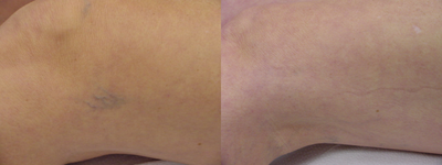 Sclerotherapy before and after photo