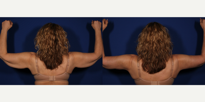 Arm Lift before and after photo