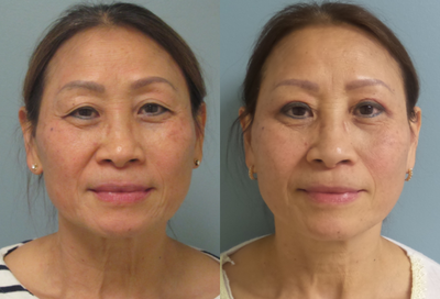 Double Eyelid Surgery before and after photo