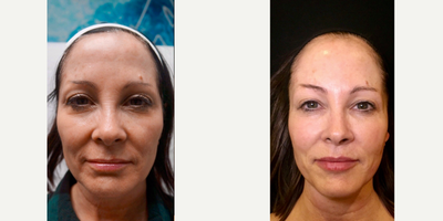 Juvederm before and after photo