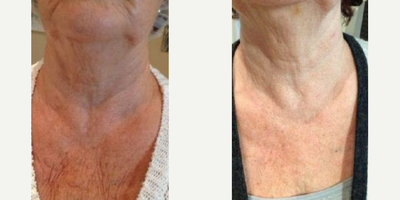 Microneedling RF before and after photo