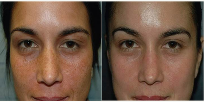 VI Peel before and after photo