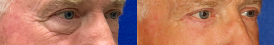 Eyelid Surgery before and after photo