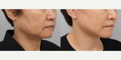 Liposuction before and after photo