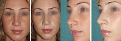 Revision Rhinoplasty before and after photo