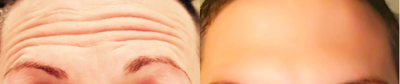 Botox before and after photo