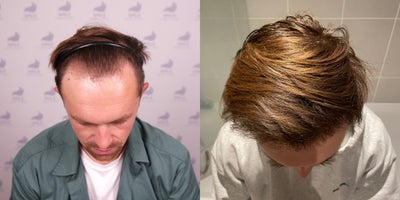 Eyebrow Transplant before and after photo