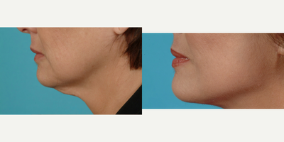 Facelift before and after photo