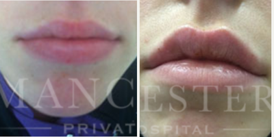Lip Fillers before and after photo
