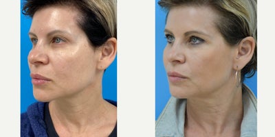 Lower Facelift before and after photo