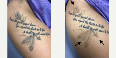 Tattoo Removal before and after photo
