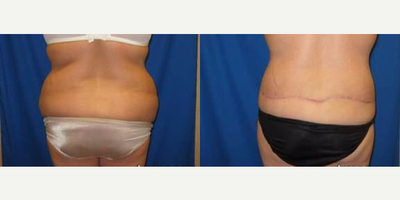 Body Lift before and after photo