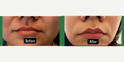 Botox before and after photo