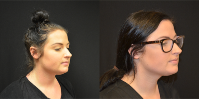 Liposculpture before and after photo
