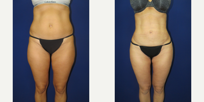 Liposuction before and after photo