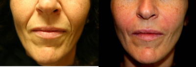 Restylane Lyft before and after photo
