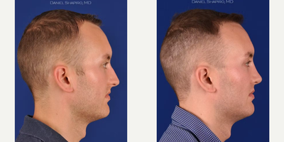 Rhinoplasty before and after photo