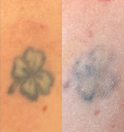 Tattoo Removal before and after photo
