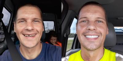 All-on-4 Dental Implants before and after photo
