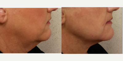 Bellafill before and after photo