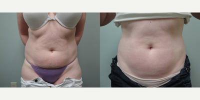 CoolSculpting before and after photo