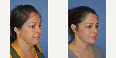 Facelift before and after photo