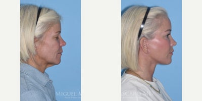 Facial Fat Transfer before and after photo