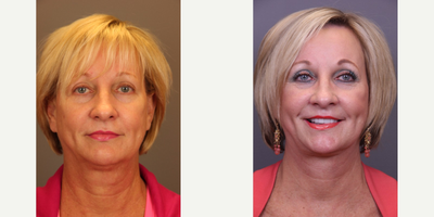 Mini Facelift before and after photo