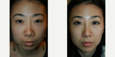 Rhinoplasty before and after photo