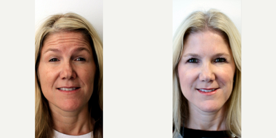 Botox before and after photo