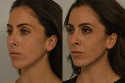 Dermal Fillers before and after photo