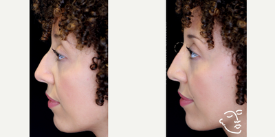 Dermal Fillers before and after photo