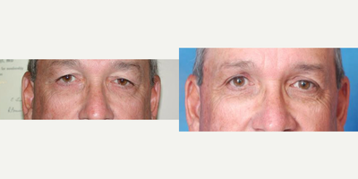 Eyelid Surgery before and after photo