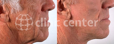 Facelift before and after photo