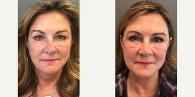 Facelift before and after photo