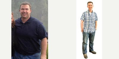 Gastric Sleeve Surgery before and after photo