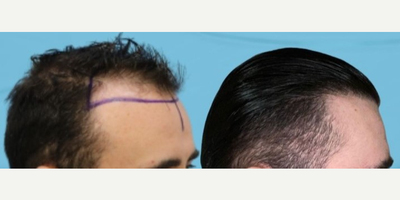 Hair Transplant before and after photo