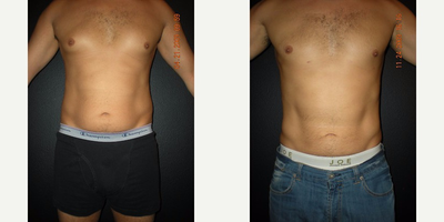 Liposuction before and after photo