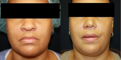 Rhinoplasty before and after photo