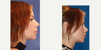 Rhinoplasty before and after photo