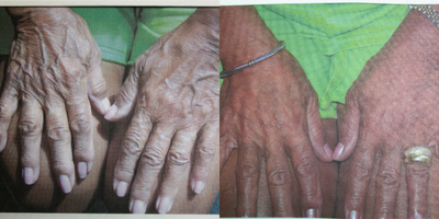 Skin Tightening before and after photo