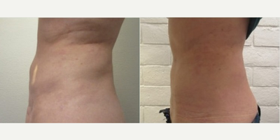 BodyTite before and after photo