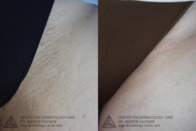 Laser Hair Removal before and after photo