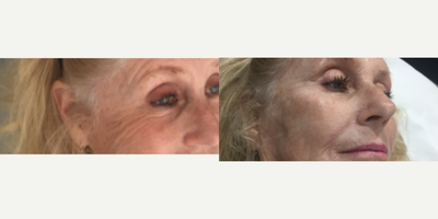 Radiesse before and after photo