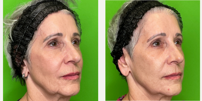 Skin Rejuvenation before and after photo