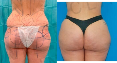 Liposculpture before and after photo
