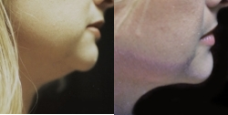 Liposuction before and after photo
