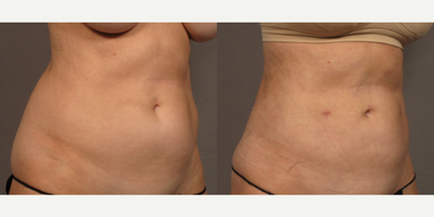 Liposuction before and after photo
